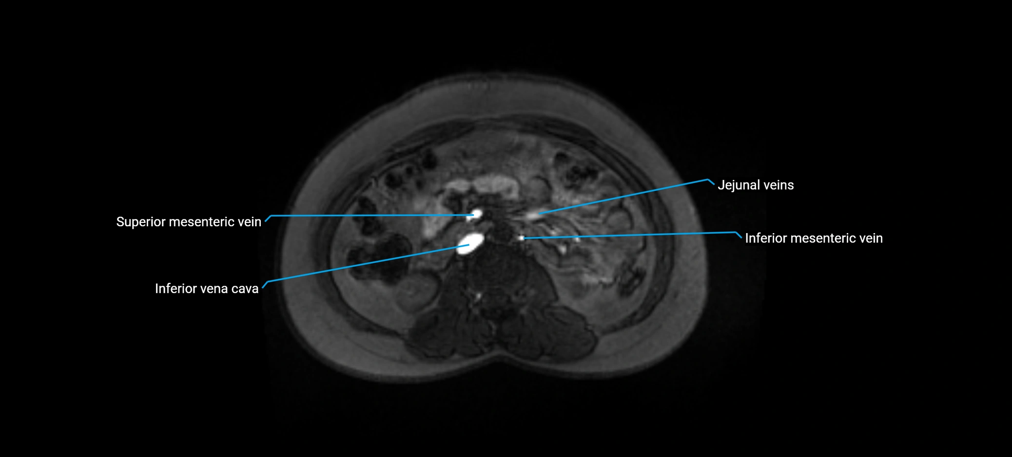 MRV abdomen pelvis & lower limb axial cross sectional anatomy labelled MRI image 83 (1).webp